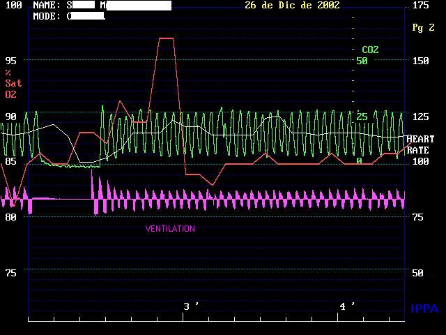 High Altitude Pulmonary Edema Medical Case Discussion IPPA
