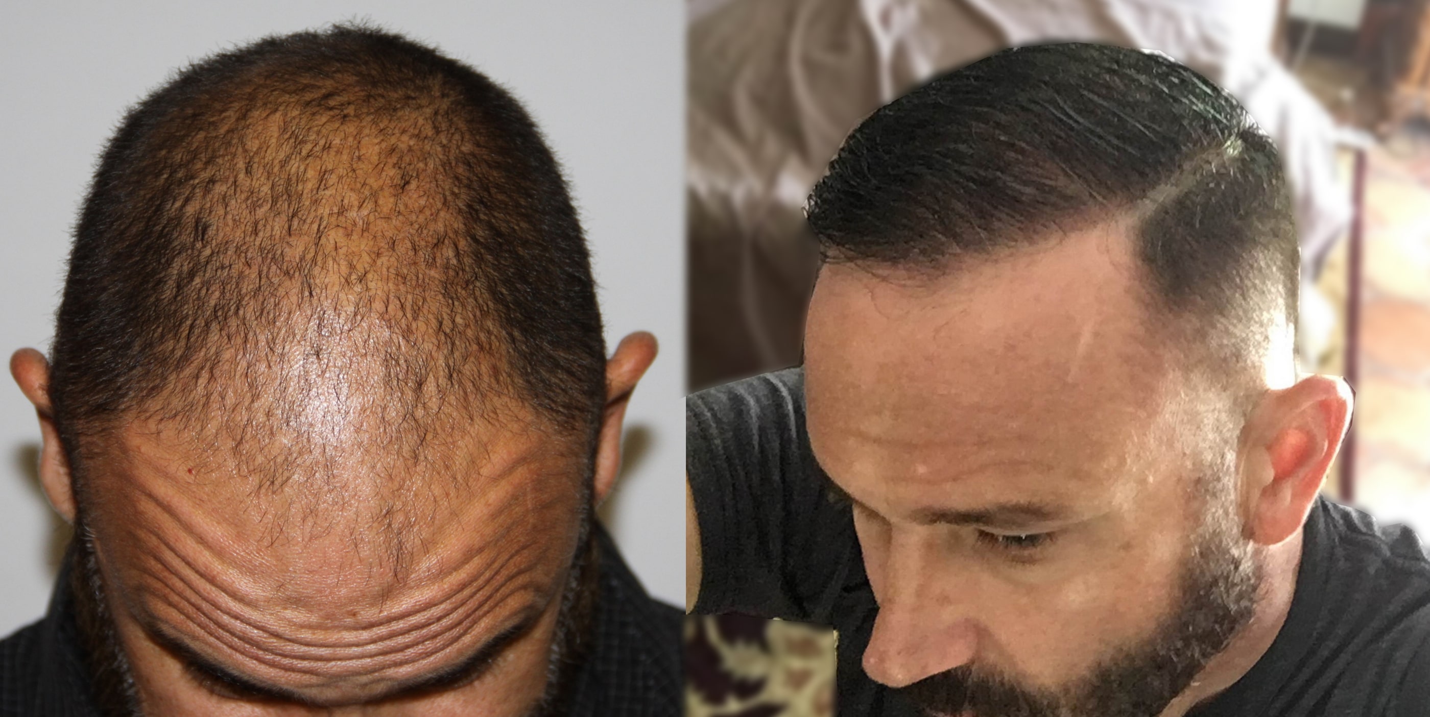 Norwood 5 Hair Restored Alvi Armani Hair Transplant Los Angeles