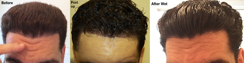 Noshave FUE Hair Transplant 1,500 Grafts Alvi Armani Hair
