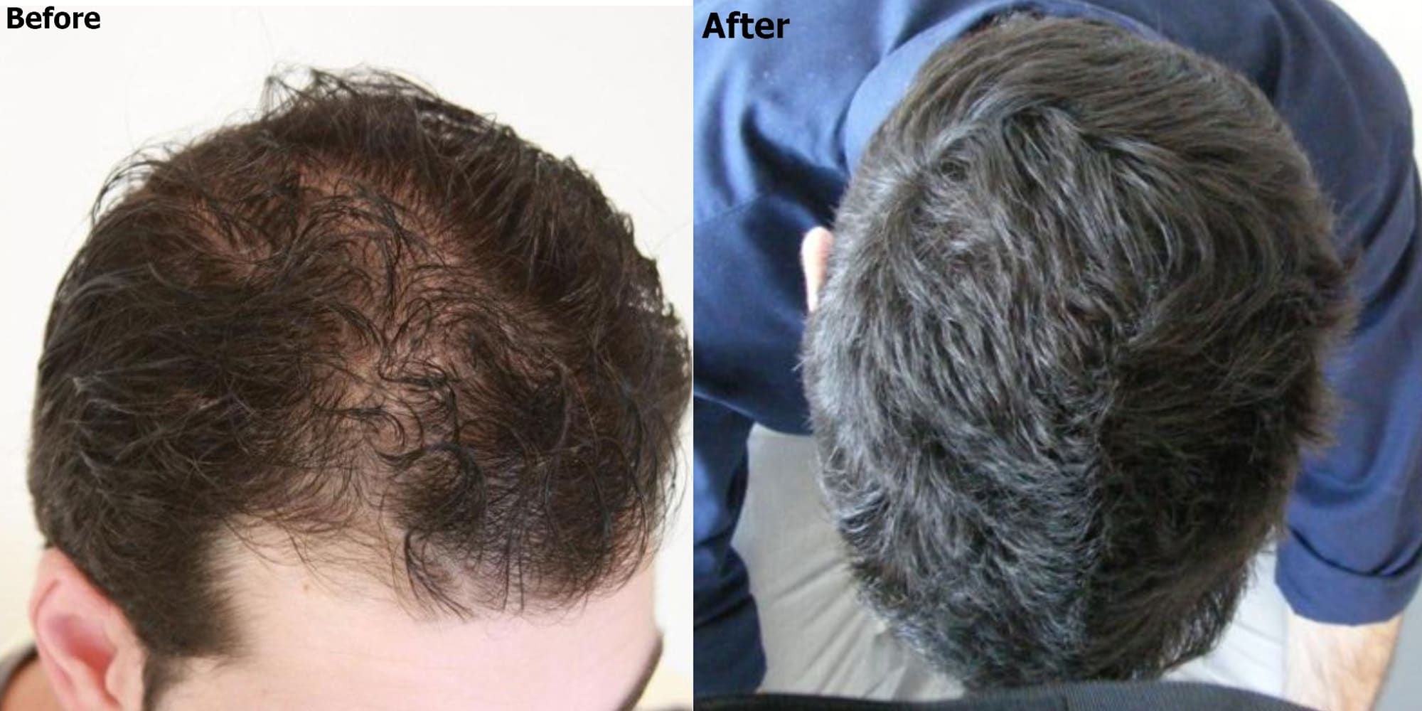 4,000 Graft FUE Hair Transplant For Diffuse Hair Loss Alvi Armani