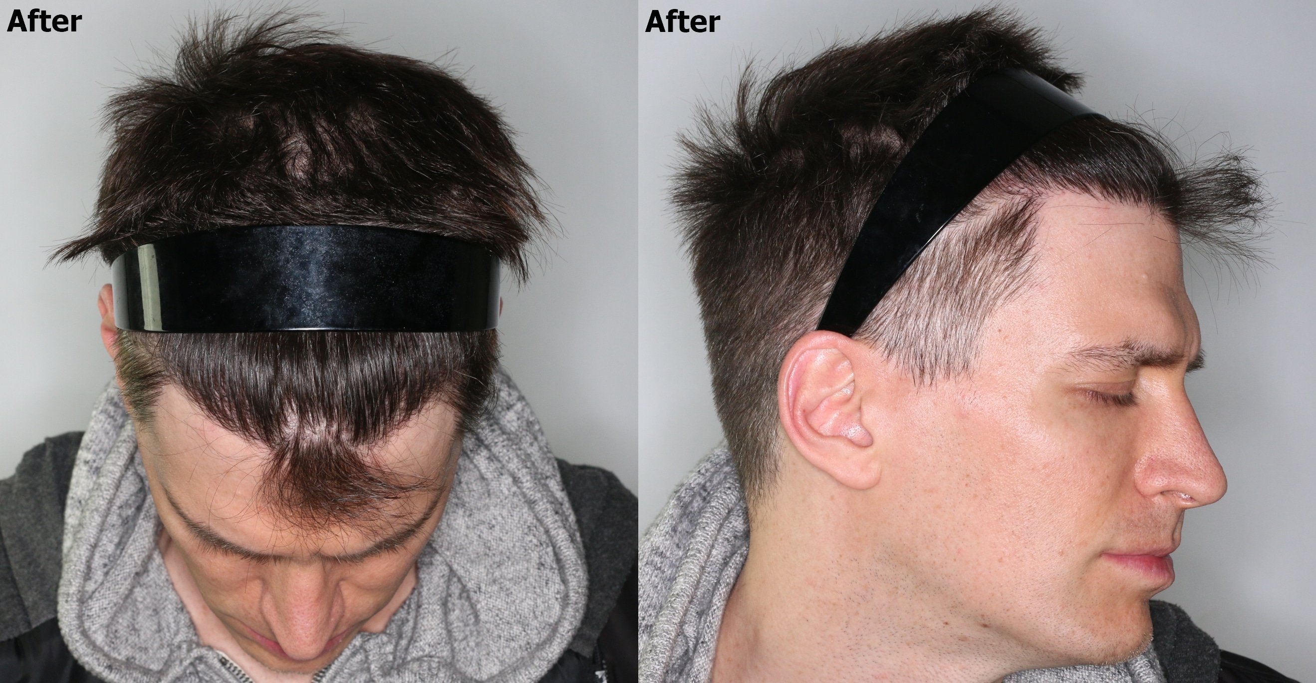 Temple Recession Restored with FUE + PRP Alvi Armani Hair