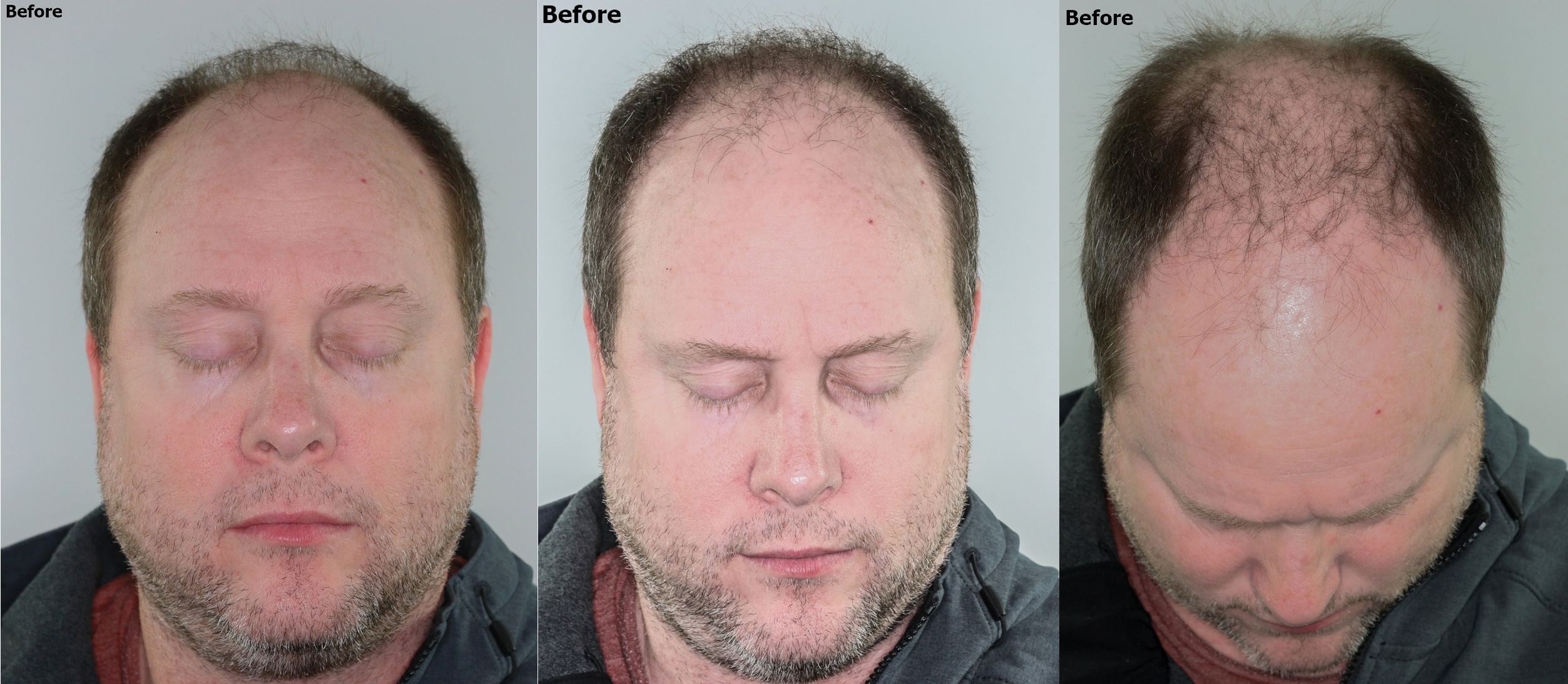 Norwood 6 Hair restoration Alvi Armani Hair Transplant Los Angeles