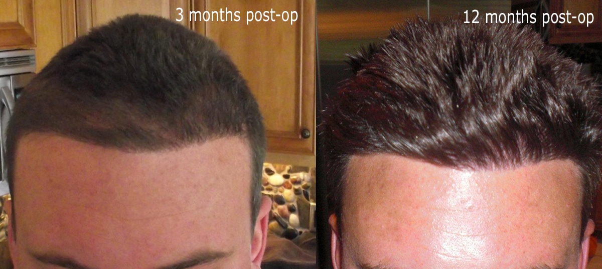 Diffuse Thinning Hair Restoration Result Alvi Armani Hair