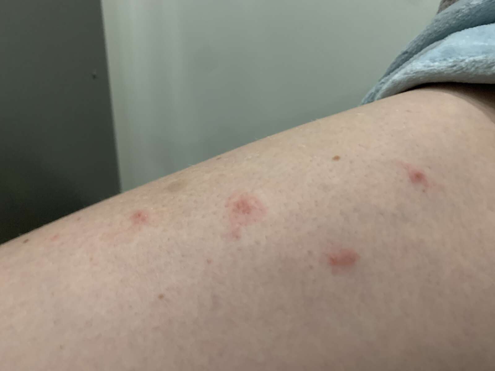 Poll Have you gotten the infamous mite bite in Alexandria? ALXnow
