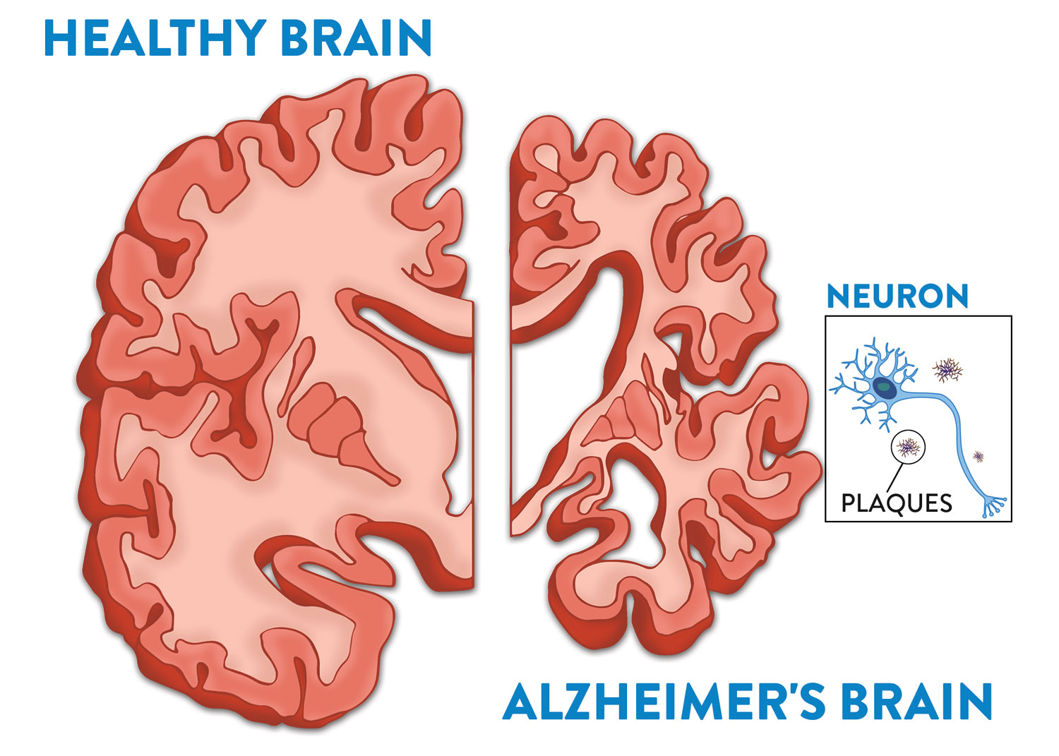 Your Brain and Alzheimer's Fisher Center for Alzheimer's Research