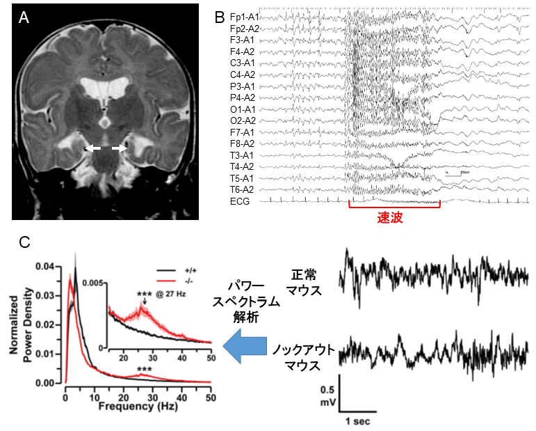 小児期の難治性てんかん（ウエスト症候群）の責任遺伝子の同定―患者と類似した脳波異常がノックアウトマウスでも確認― 国立研究開発法人日本医療