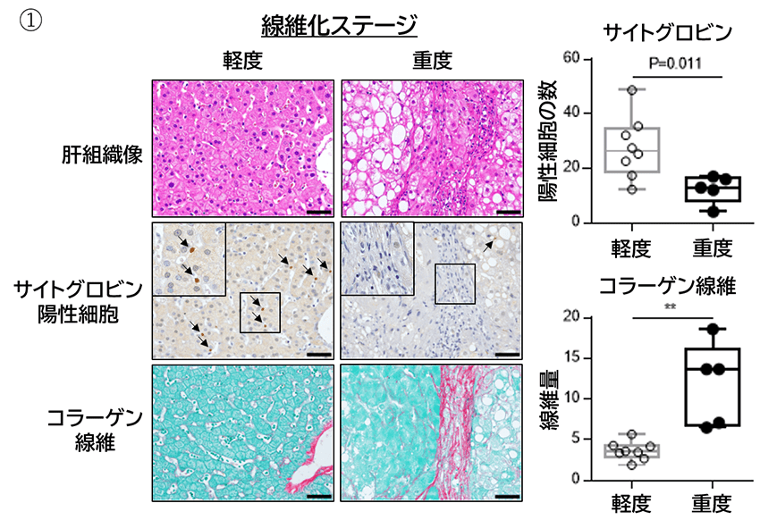 脂肪肝炎の新たな治療法開発に期待！―サイトグロビンの発現と肝線維化の関係が明らかに― 国立研究開発法人日本医療