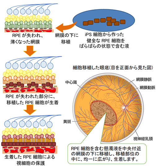 Ips 細胞 網膜 ニュース baitpoxxy