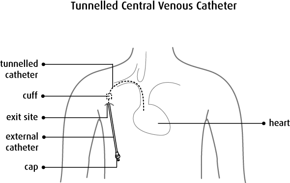 Superb tips for Tunneled Central Venous Catheter CPT codes Medical Coding Guide