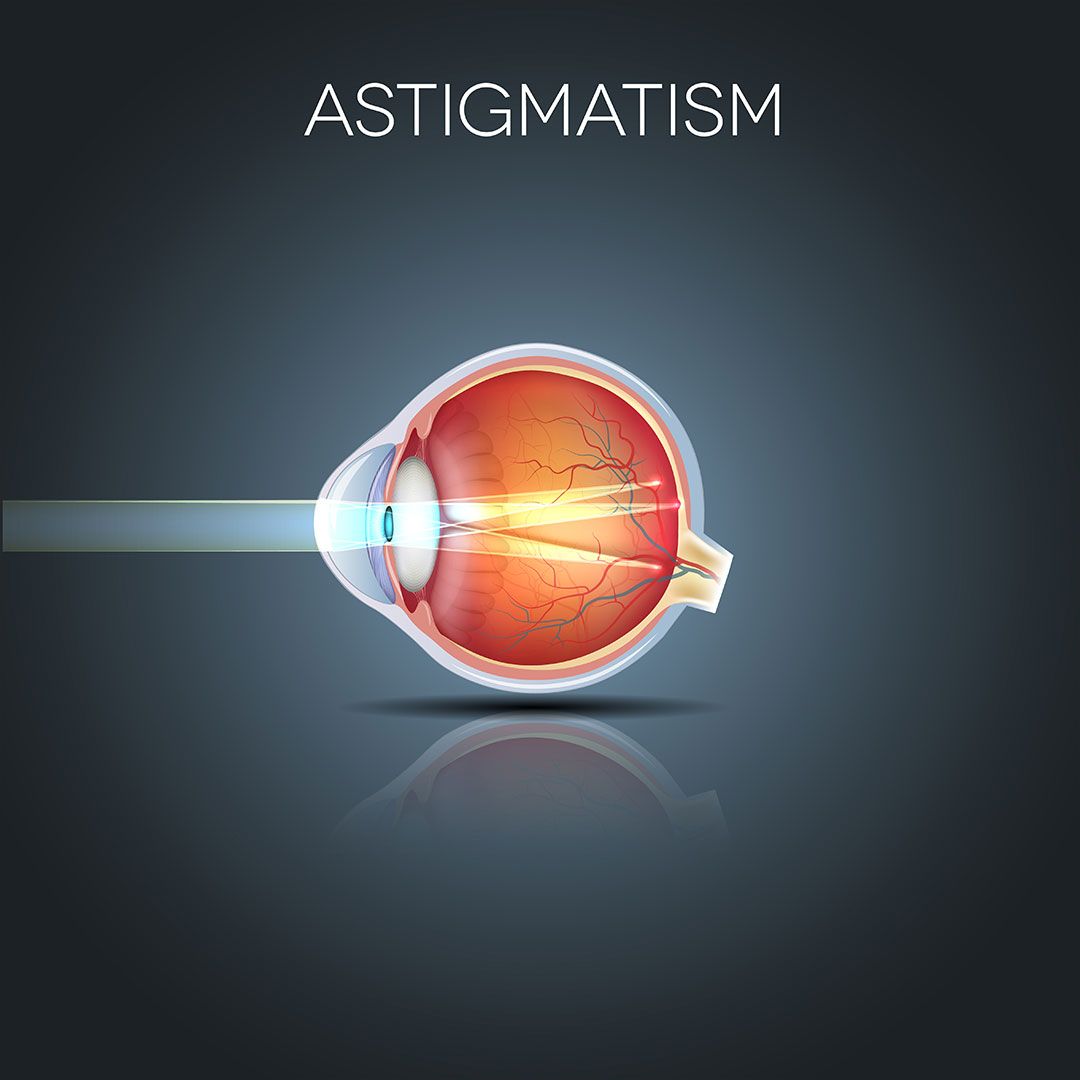 What Is Astigmatism? Symptoms & Treatments Mr Amit Patel What Is Astigmatism? Symptoms & Treatments Mr Amit Patel