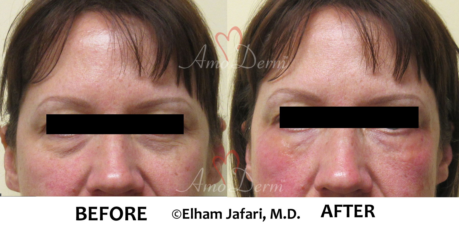 Dark Circles Under Eyes Cosmetic Treatments Before and After Pictures