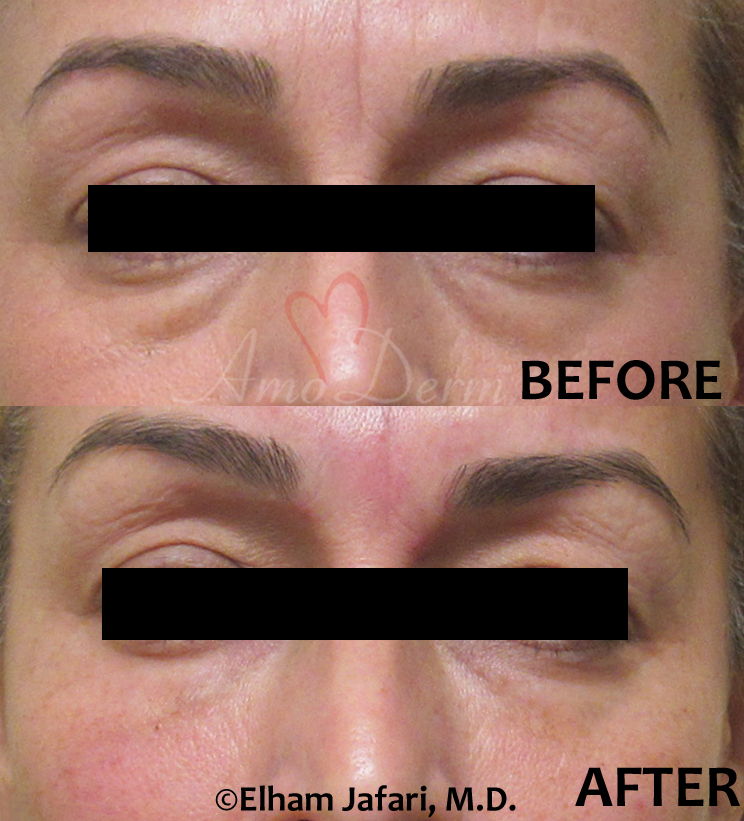 Dark Circles Under Eyes Cosmetic Treatments Before and After Pictures