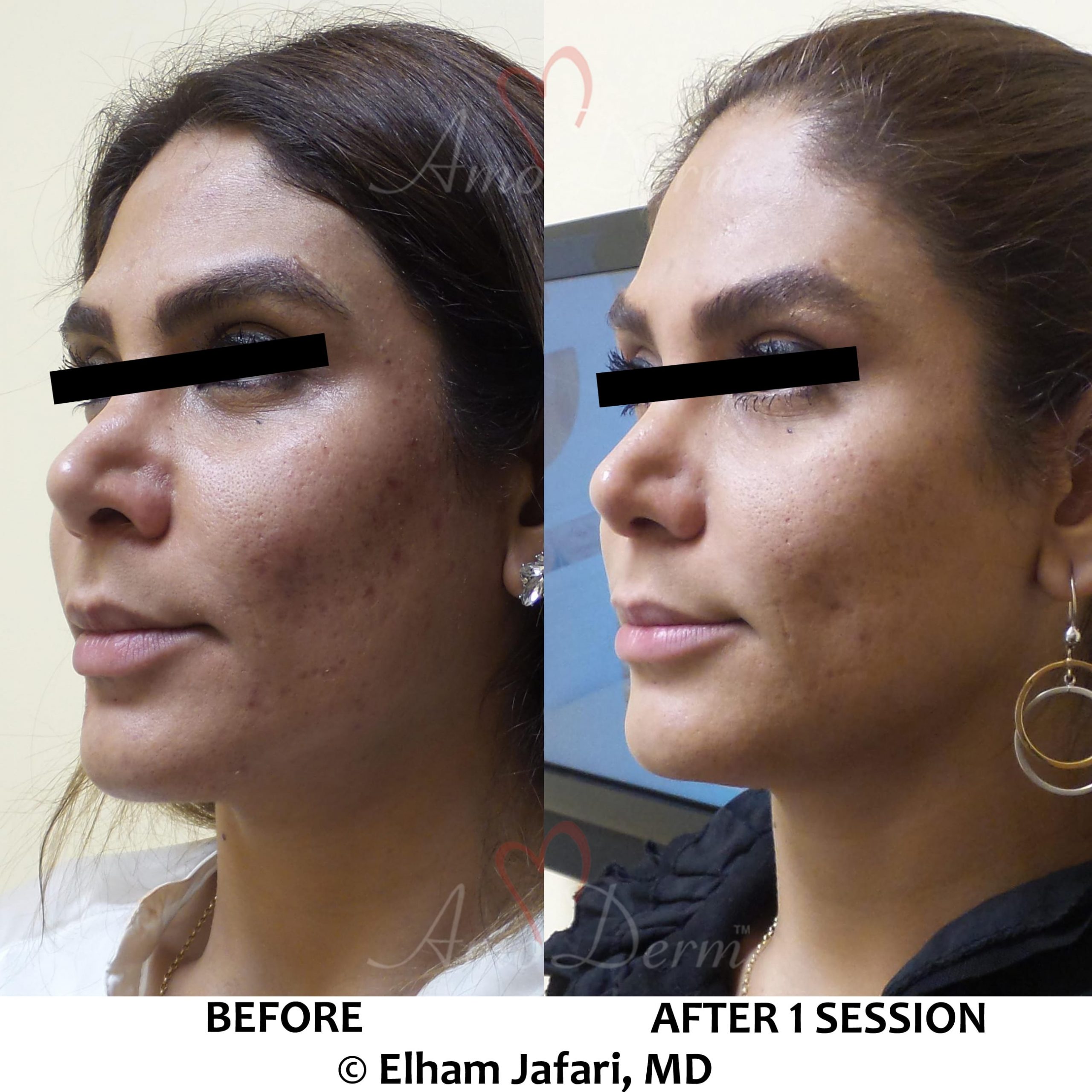 Albums 91+ Pictures Laser Treatment For Acne Scars Before And After
