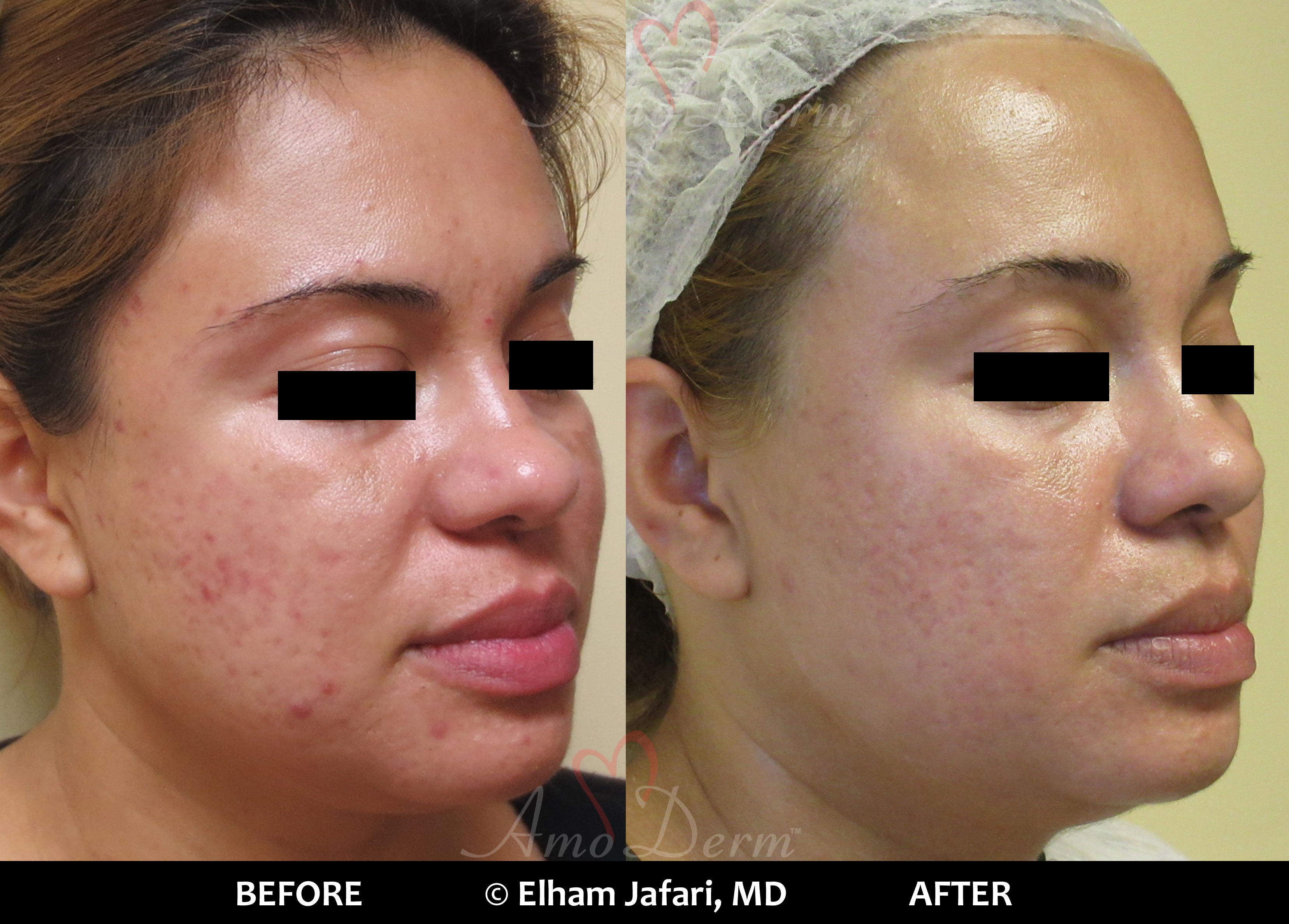 Acne Scars and Laser Acne Scar Removal at Amoderm Irvine