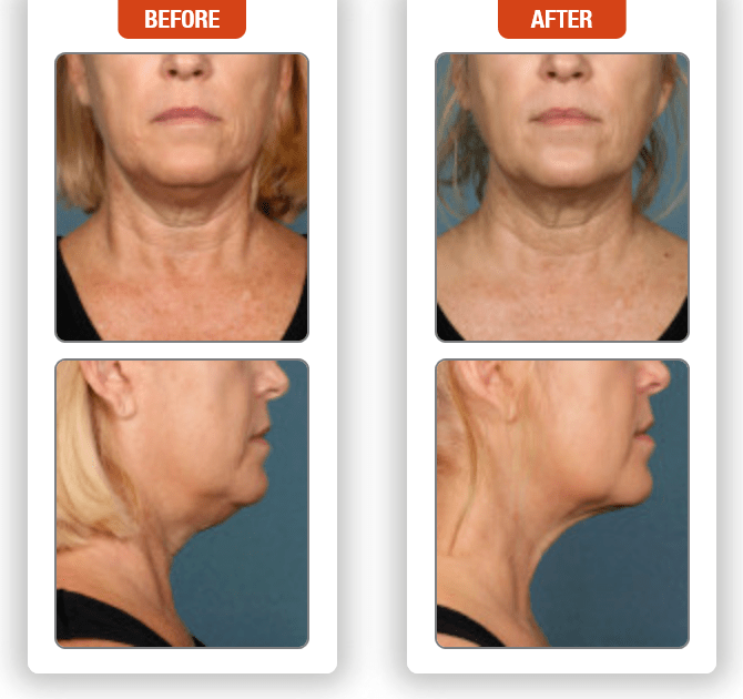 Kybella in Orange County, Irvine and Newport Beach