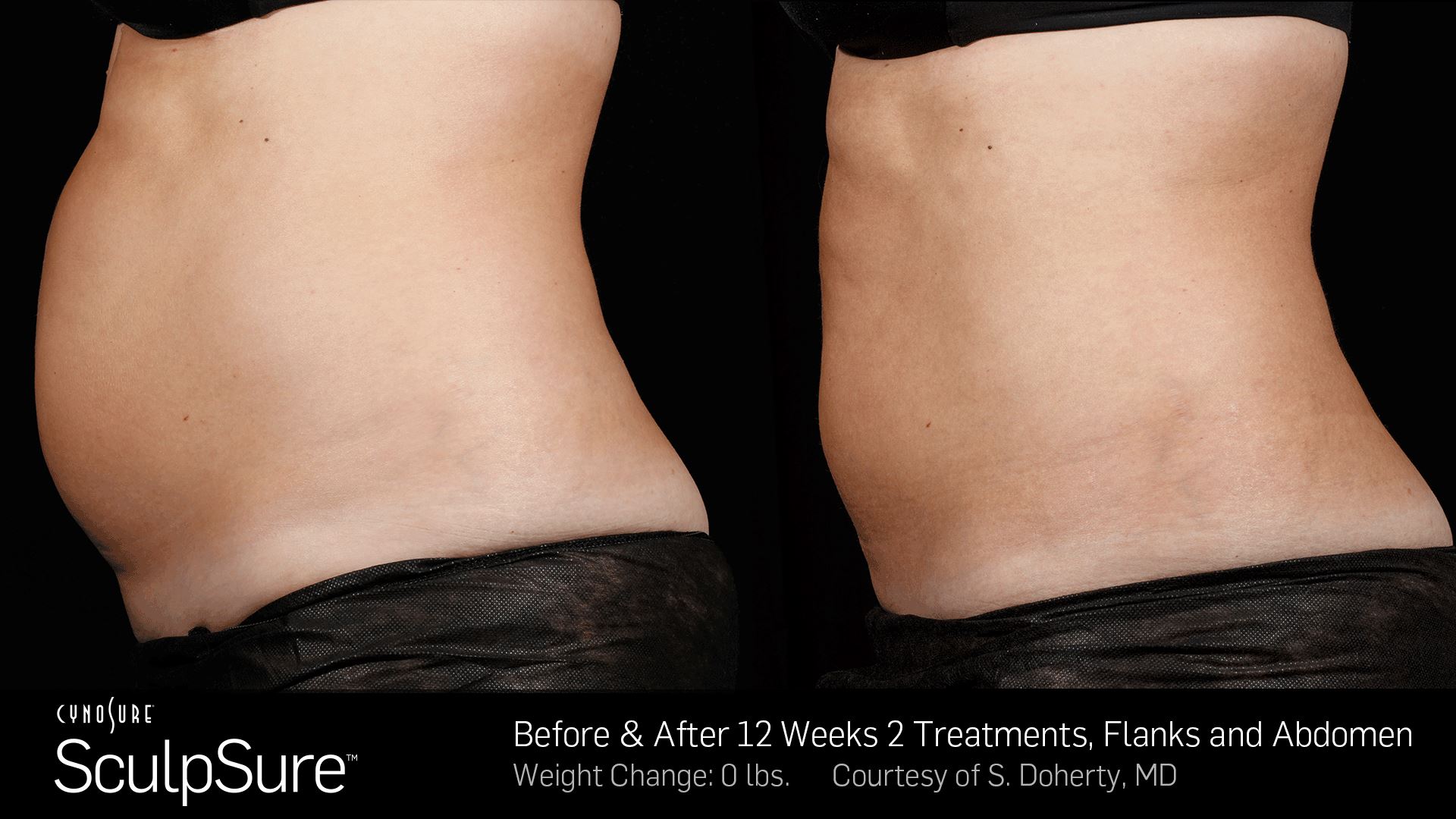 SculpSure NonSurgical Body Contouring Treatments in Irvine