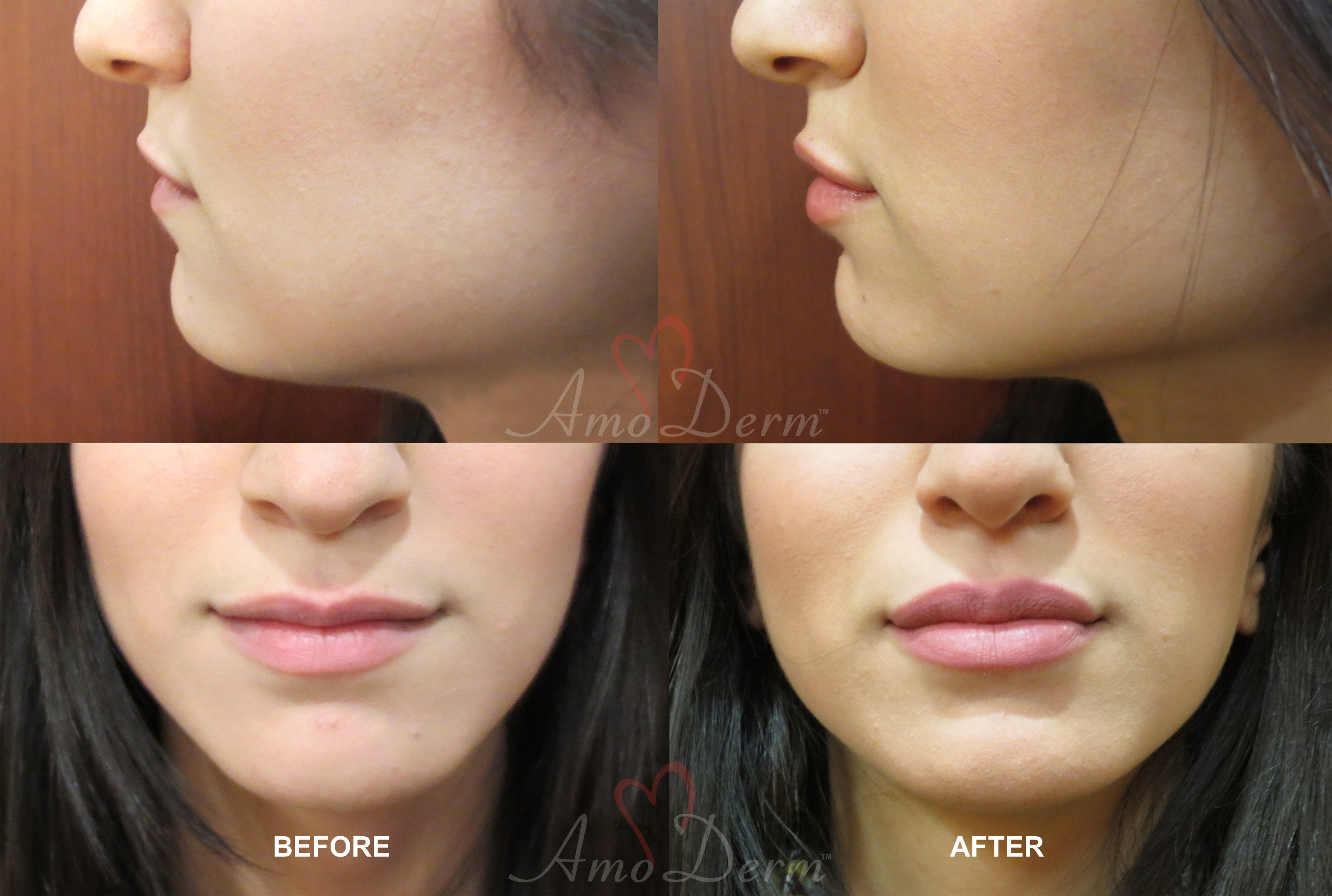 Lip Augmentation Irvine Lip Injections, Lip Fillers, Orange County