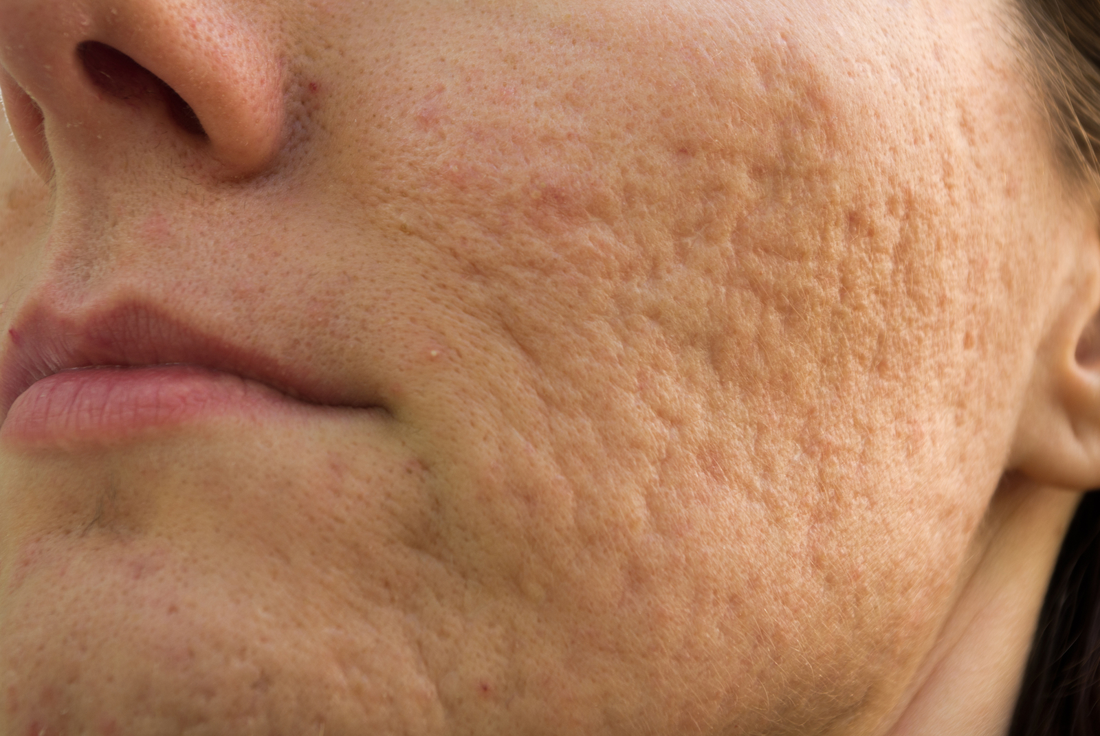 Acne Scars and Laser Acne Scar Removal at Amoderm Irvine