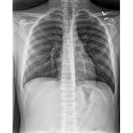 Baseball Sliding Injury