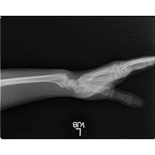 Bilateral Wrist Pain In A Teenage Gymnast
