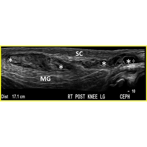 Knee Pain Secondary To Zumba Class