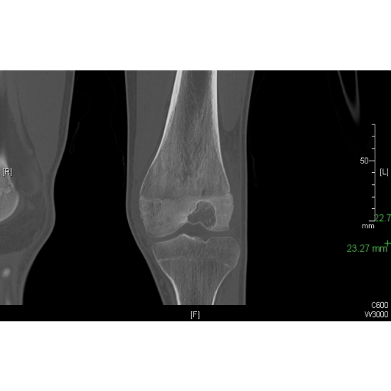 Knee Pain And Muscle Atrophy In A Football Player