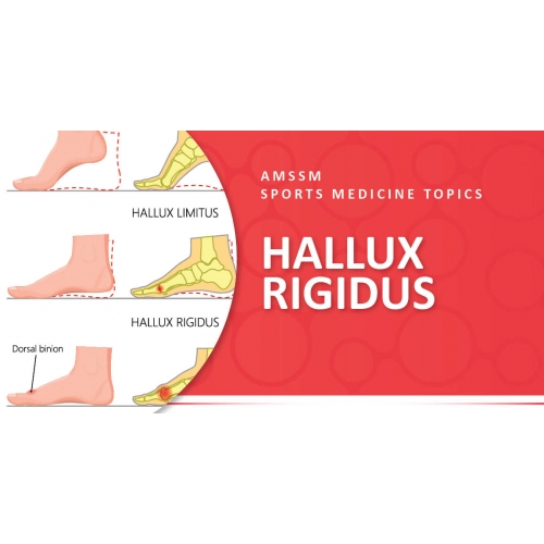 Hallux Rigidus