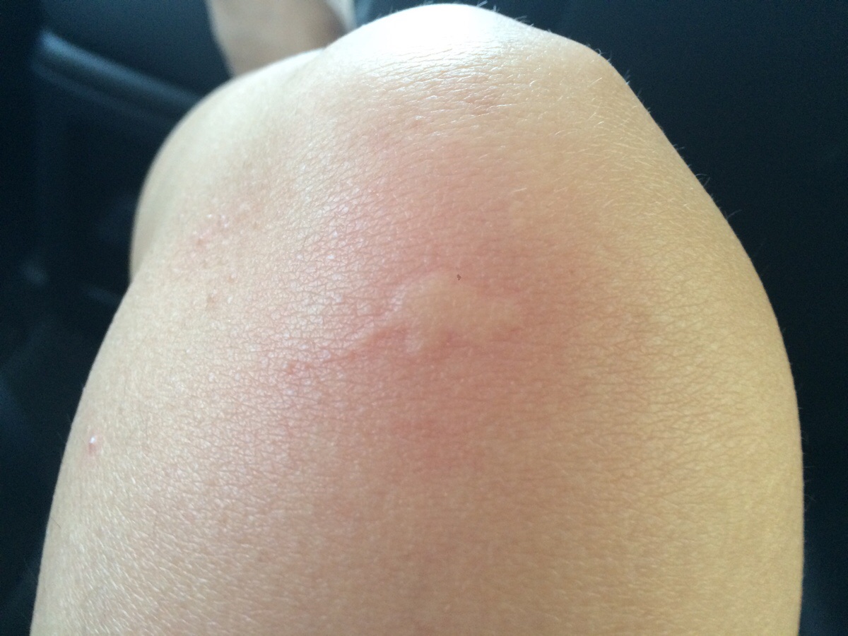 How CBD Stops Mosquito Bite Itching Fast Amsterdam