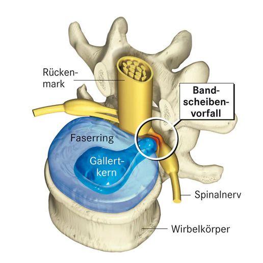Physiotherapie bei einem Bandscheibenvorfall ANAMETRICS
