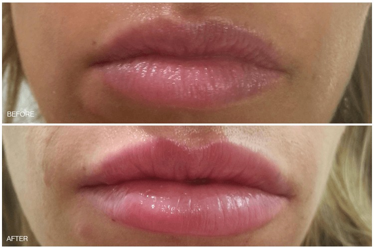 NonSurgical Solutions/Juvederm® Anaphora by Dr. Christine Ibrahim