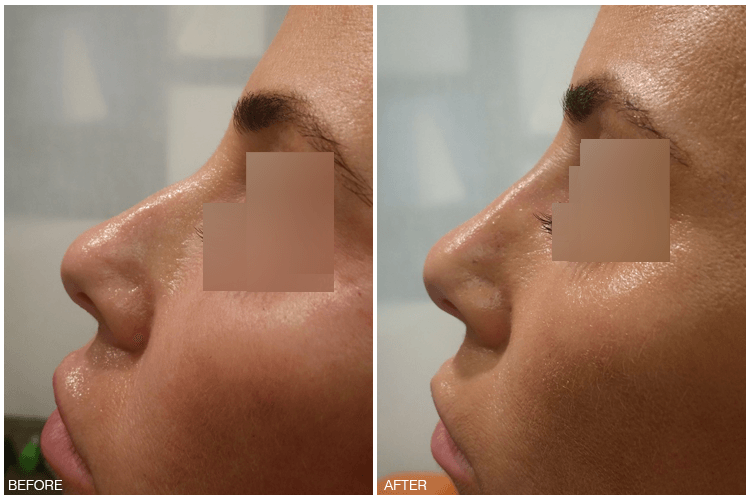 NonSurgical Solutions/Radiesse® Anaphora by Dr. Christine Ibrahim