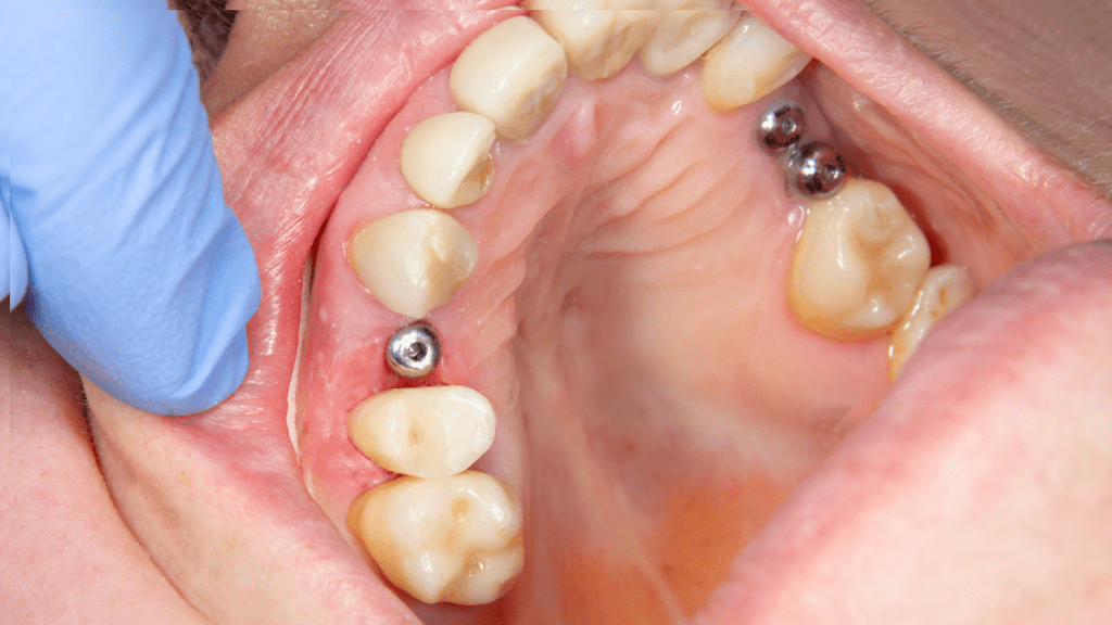 What to look for in a Dental Implant Surgery Center? Andrew Wheatley