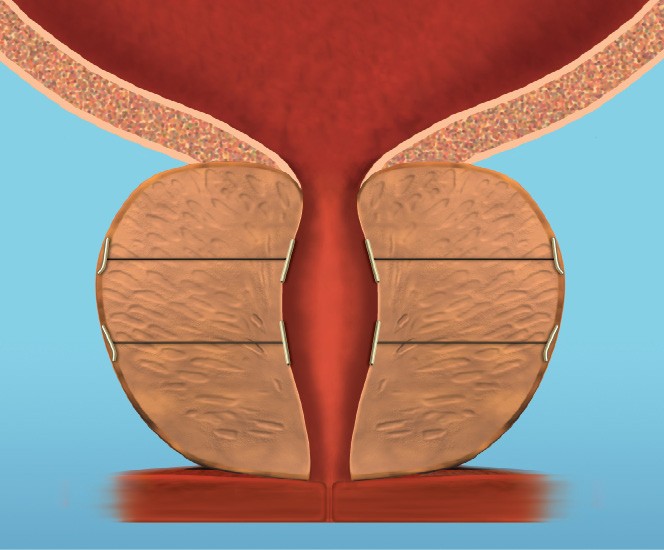 prostatesurgery