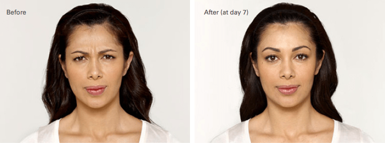 Botox Cosmetic Skin Treatments & Migraine Treatments in Merrimack, NH