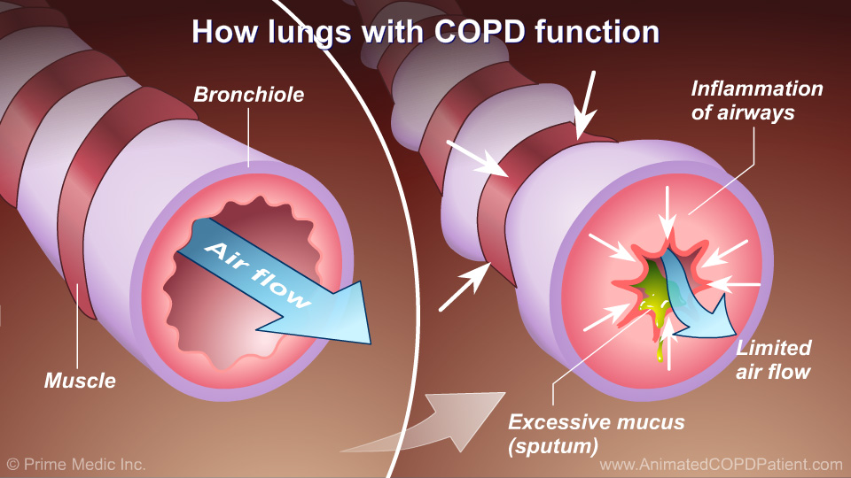 Slide Show Understanding COPD