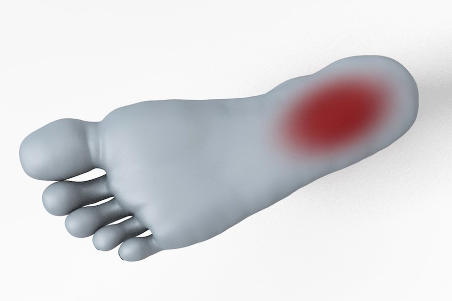 Do you get heel pain when running? Animated Physiotherapy