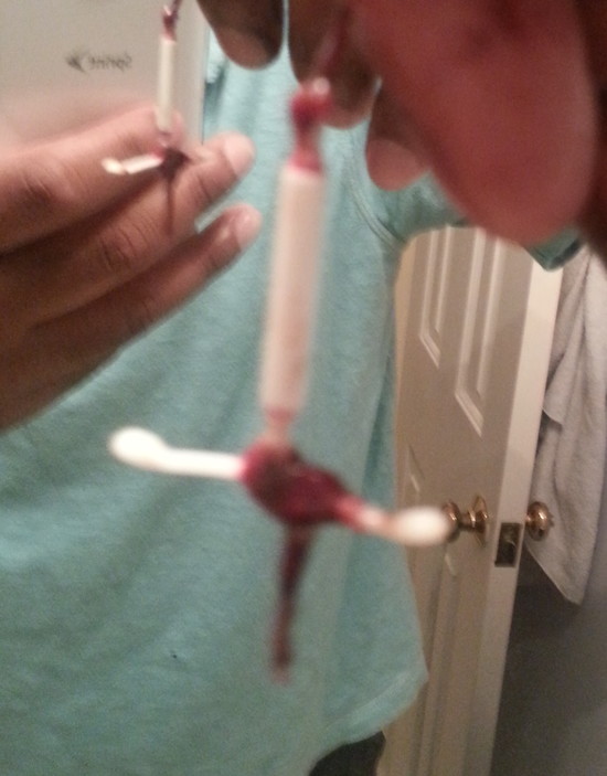 Can an IUD cause blood clots?