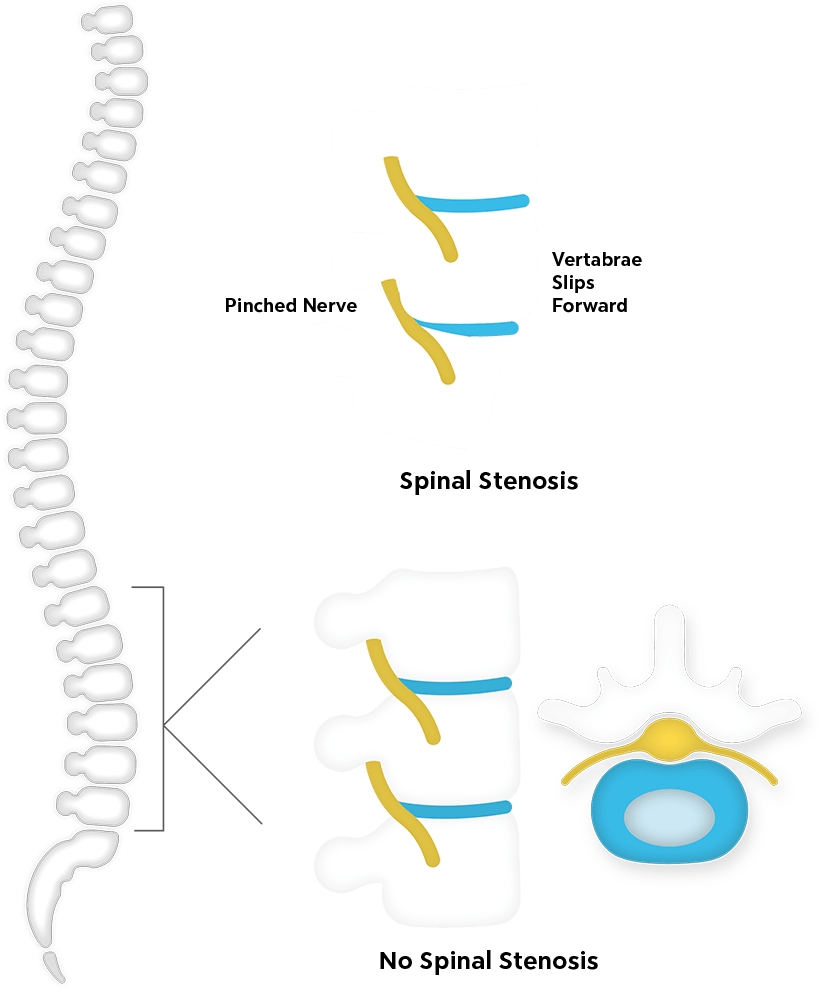 Best Chair for Spondylolisthesis