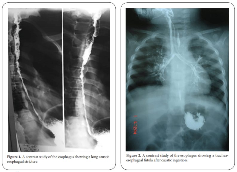 Caustic esophageal stricture from diagnosis untill cure Abdelhay Clinical Surgery Research
