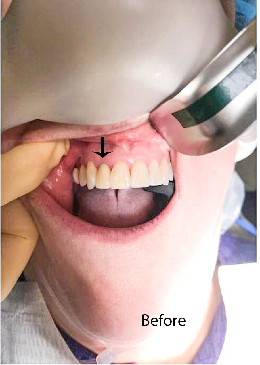 Dental Implant Temporary Kernersville Temporary Crowns WinstonSalem