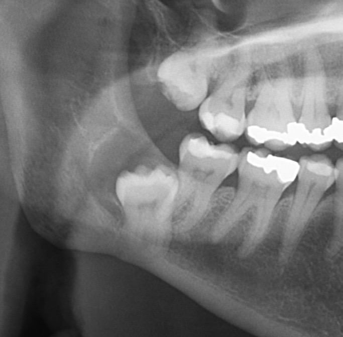 An Interesting Third Molar Case Involving a Coronectomy and Biopsy