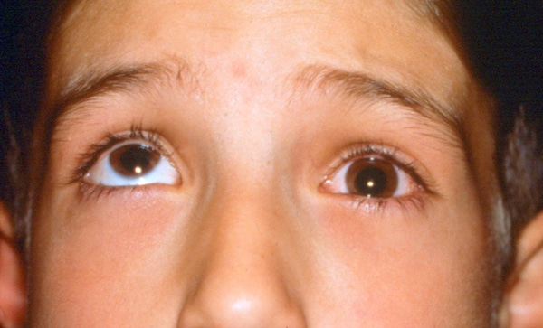 Orbital Trauma Little Rock, Eye Socket Fracture Arkansas