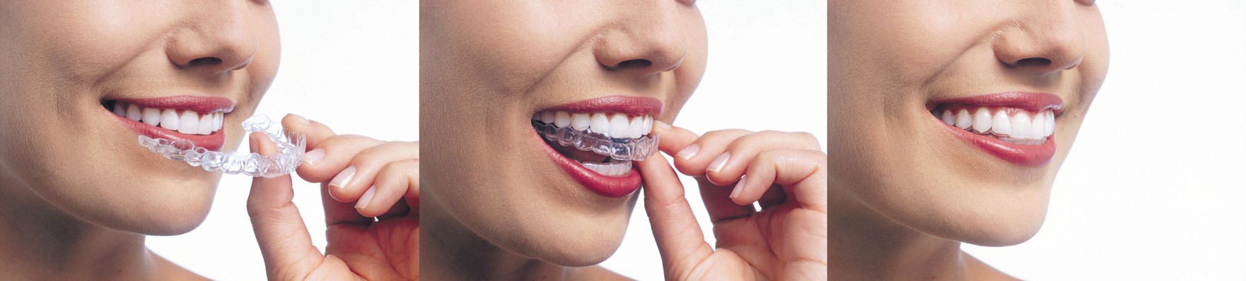 8 interesting things you should know about Invisalign before you try it