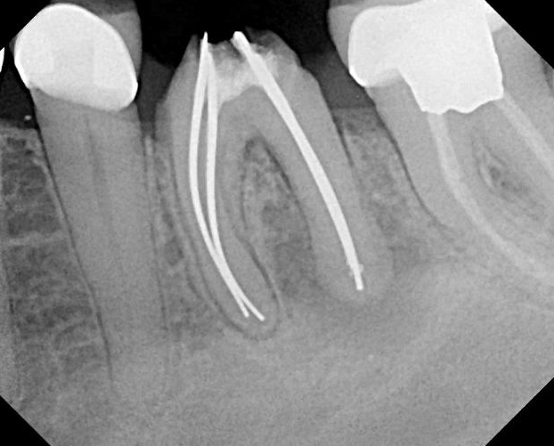 Case Studies Smyrna GA, Apex Endodontics, P.C.