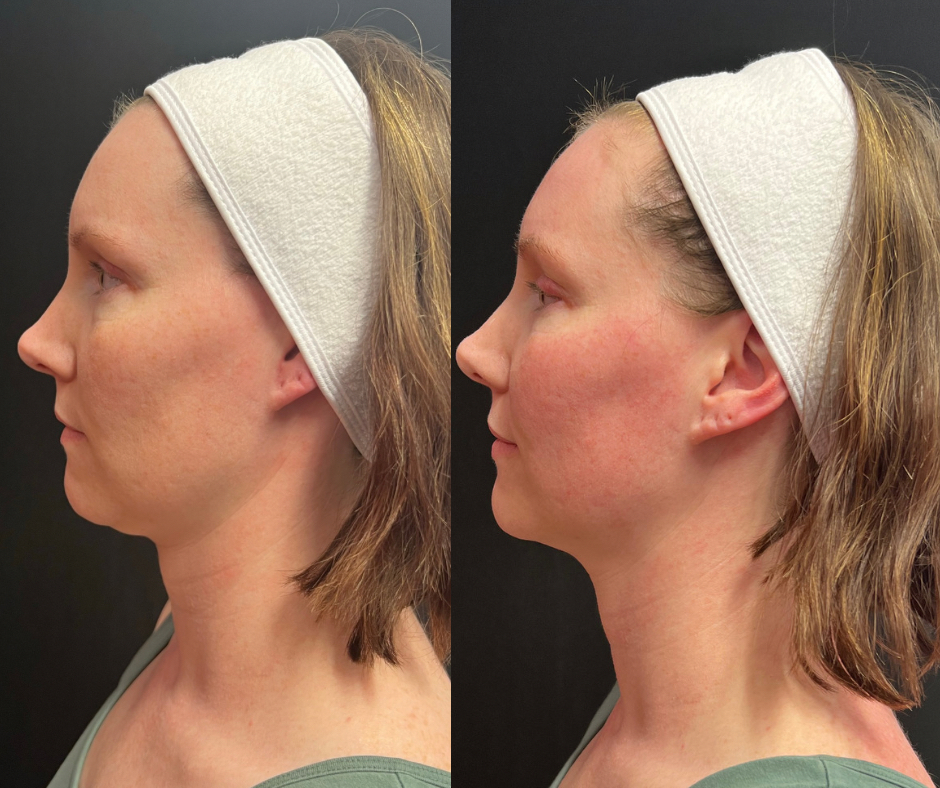 Emface Apex Dermatology & Skin Surgery Center Cleveland, OH Dermatology