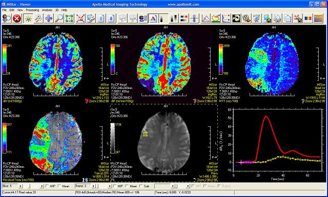 Apollo Medical Imaging Technology Stroke MR