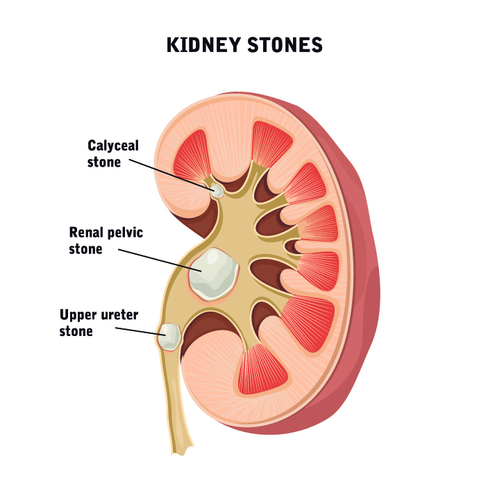 Best Kidney stone Treatment & Diagnostics in Chunni Ganj, Kanpur