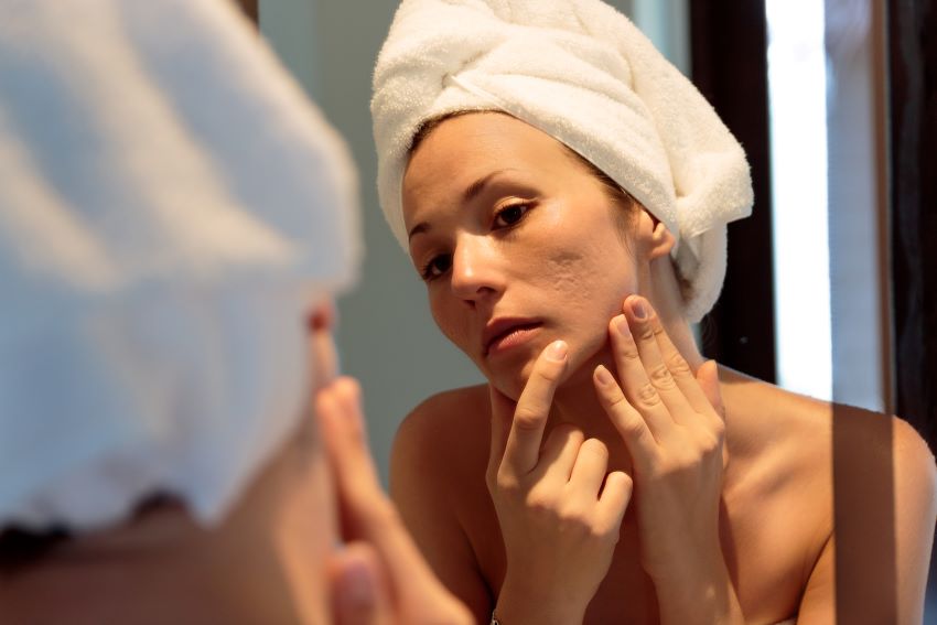 Will Acne Scars Go Away? 10 Acne Treatment Solutions