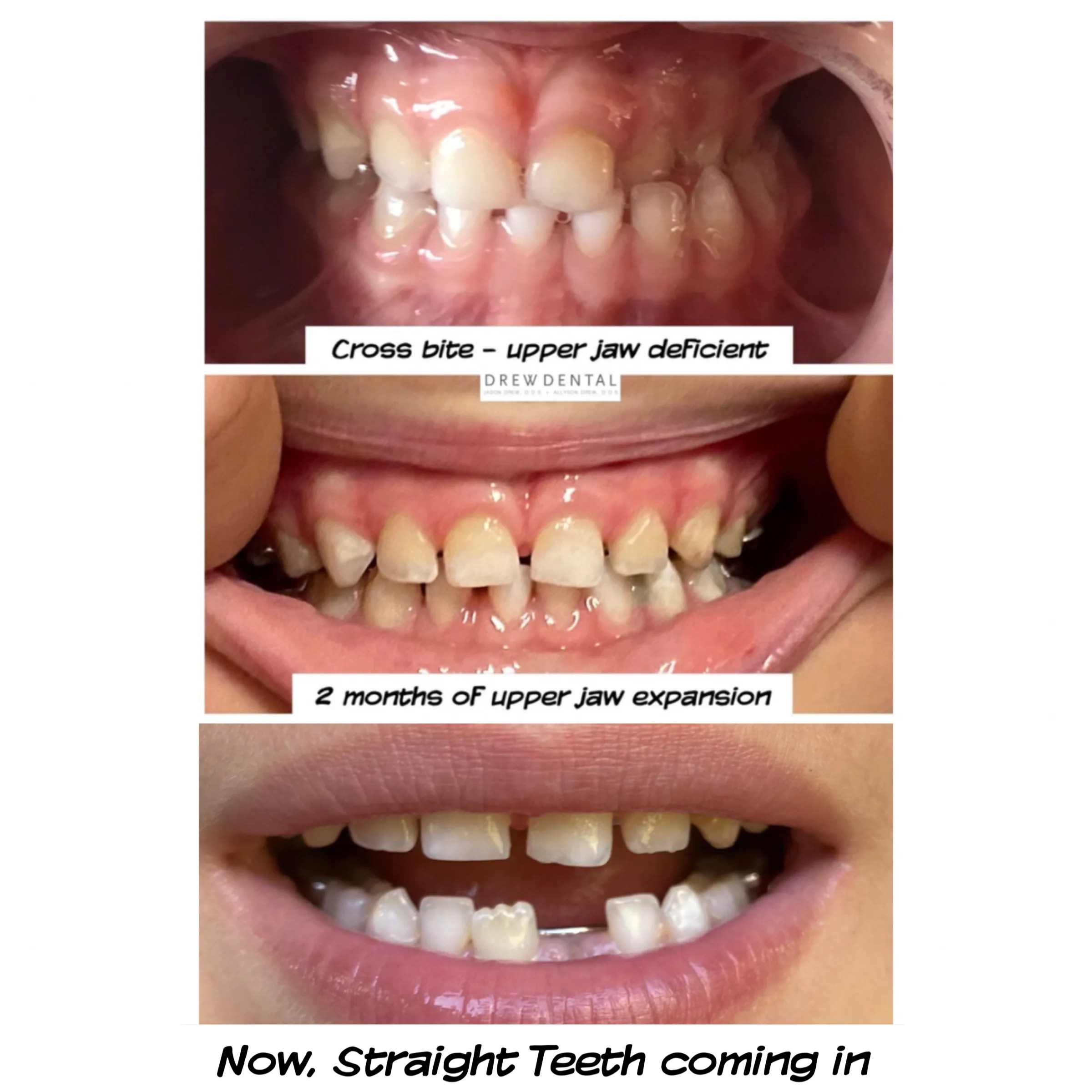 Update On Early Orthodontic Expansion Aptos Dentist Jason Drew DDS