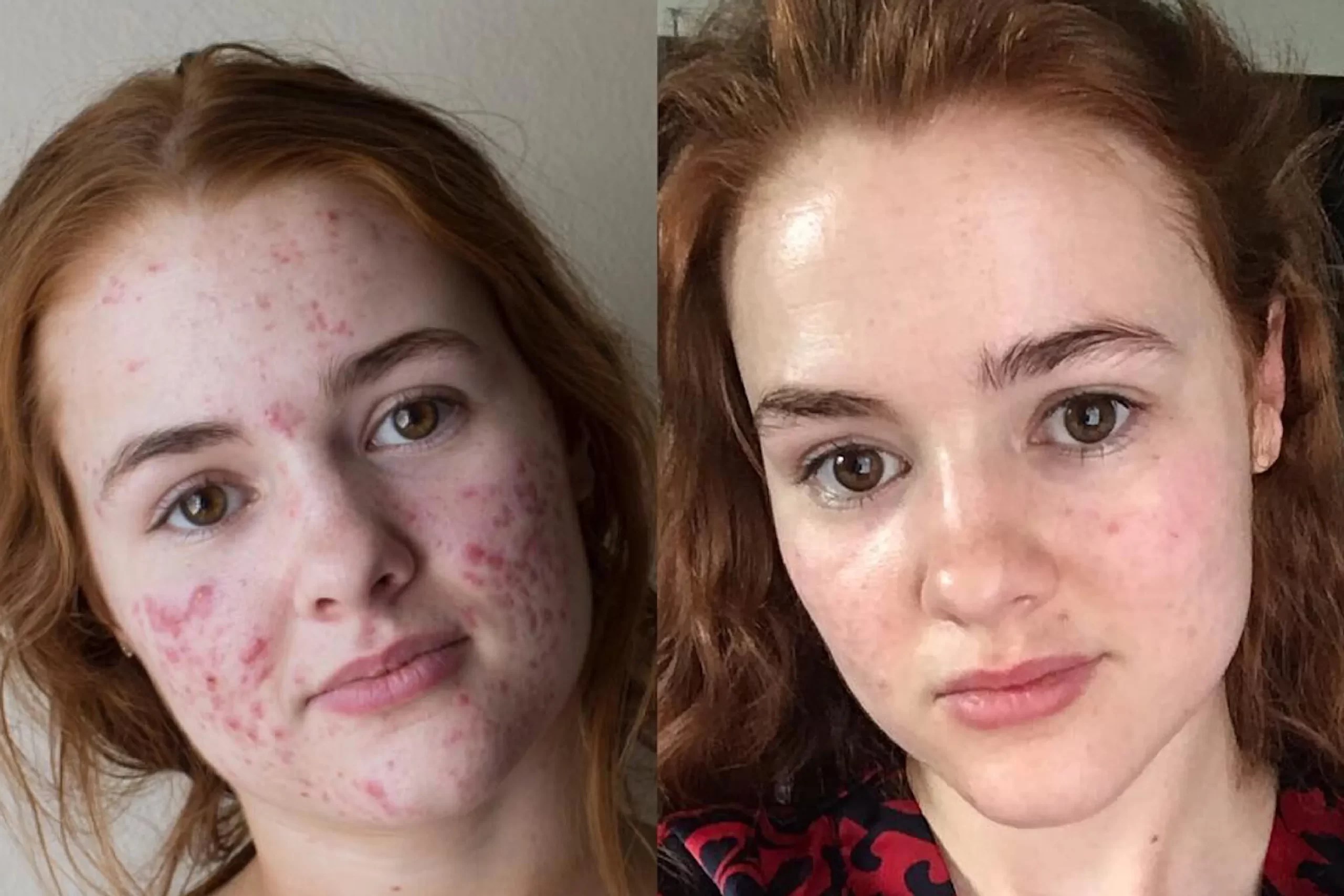 Accutane Before And After Results Is The Process Safe?